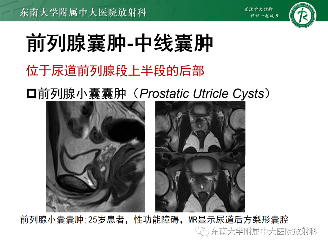 影像PPT - 【PPT】易误诊为前列腺癌的正常结构及良性病变-21