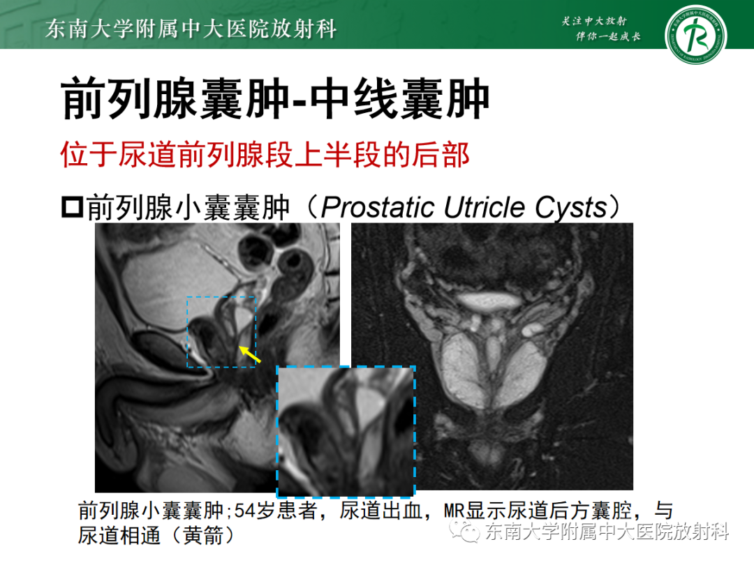影像PPT - 【PPT】易误诊为前列腺癌的正常结构及良性病变-22