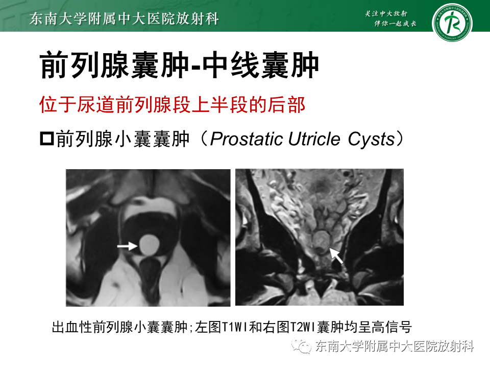 影像PPT - 【PPT】易误诊为前列腺癌的正常结构及良性病变-23