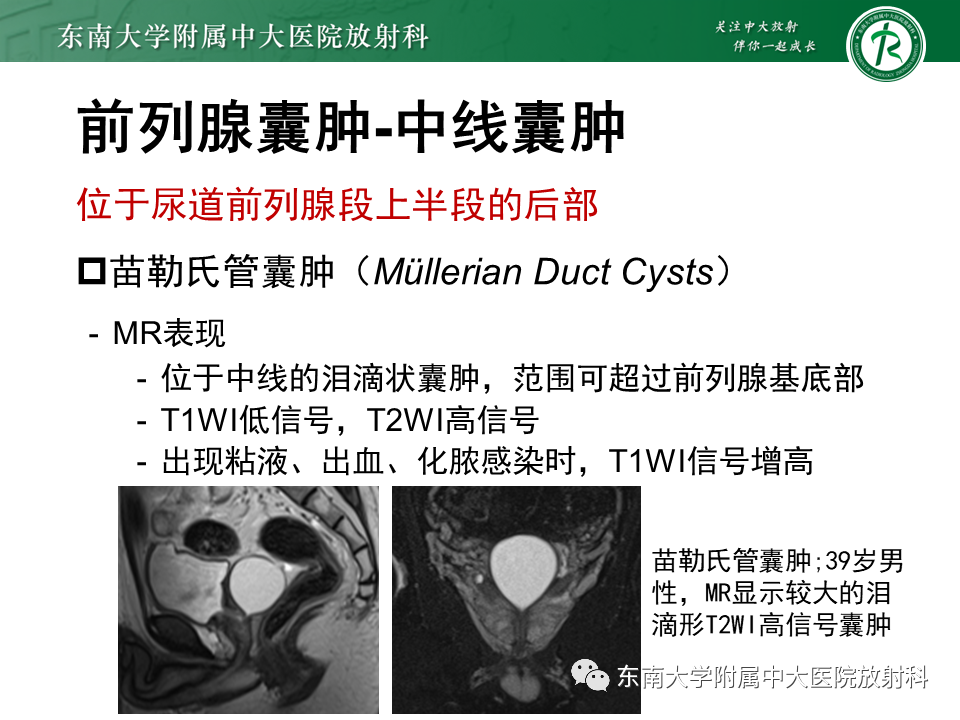 影像PPT - 【PPT】易误诊为前列腺癌的正常结构及良性病变-25