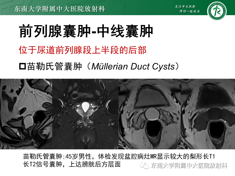 影像PPT - 【PPT】易误诊为前列腺癌的正常结构及良性病变-26