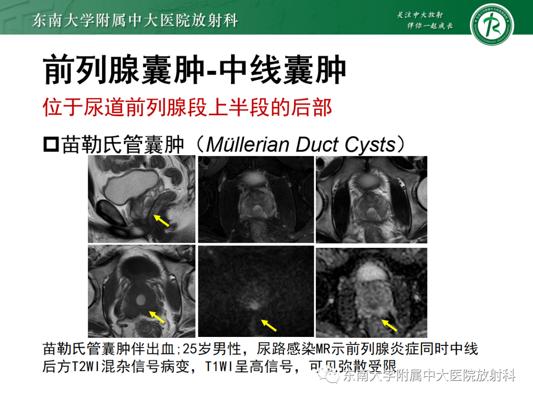 影像PPT - 【PPT】易误诊为前列腺癌的正常结构及良性病变-27
