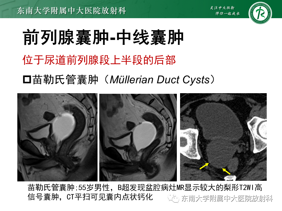 影像PPT - 【PPT】易误诊为前列腺癌的正常结构及良性病变-28