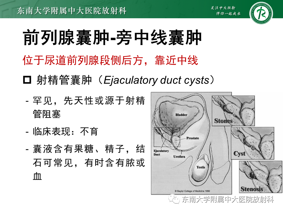 影像PPT - 【PPT】易误诊为前列腺癌的正常结构及良性病变-30