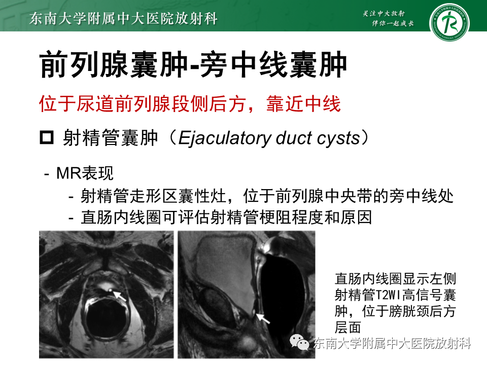 影像PPT - 【PPT】易误诊为前列腺癌的正常结构及良性病变-31
