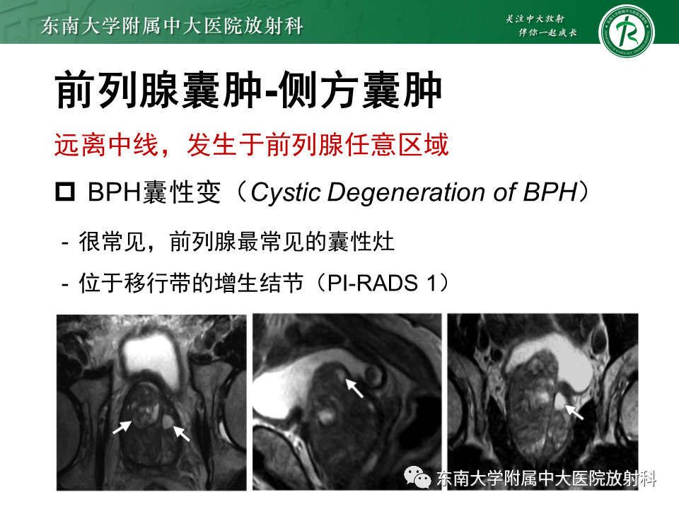 影像PPT - 【PPT】易误诊为前列腺癌的正常结构及良性病变-33