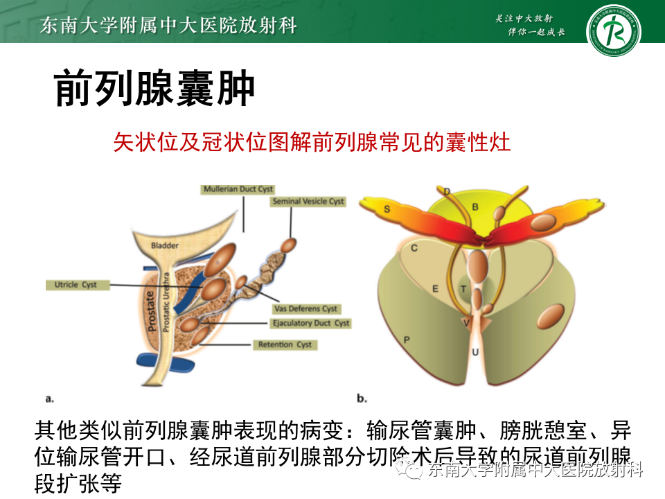 影像PPT - 【PPT】易误诊为前列腺癌的正常结构及良性病变-34