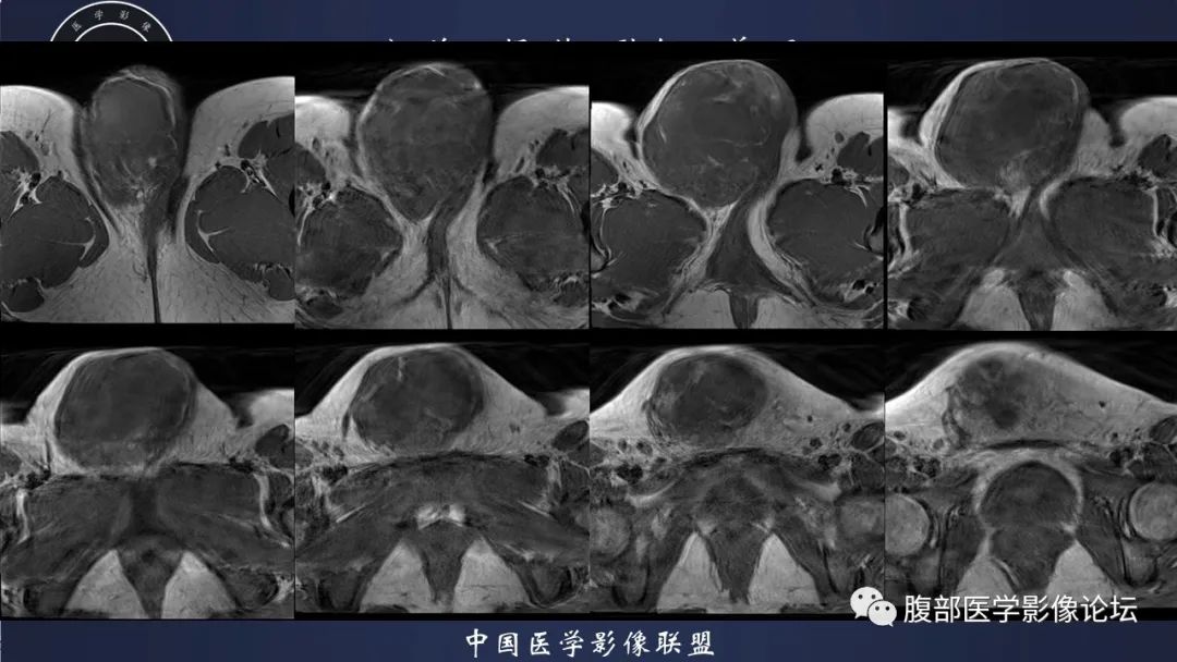 影像PPT - 【病例】外阴脂肪母细胞瘤样肿瘤1例CT及MR影像-6