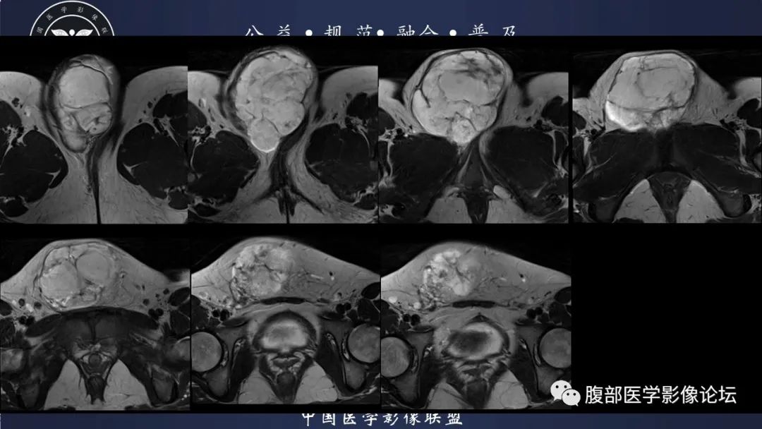 影像PPT - 【病例】外阴脂肪母细胞瘤样肿瘤1例CT及MR影像-5