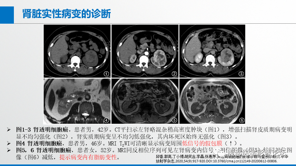 影像PPT - 【PPT】肾癌诊疗指南之诊断篇-5