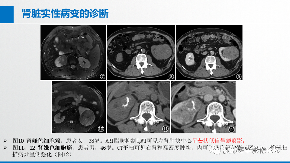 影像PPT - 【PPT】肾癌诊疗指南之诊断篇-7