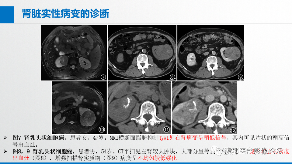 影像PPT - 【PPT】肾癌诊疗指南之诊断篇-6