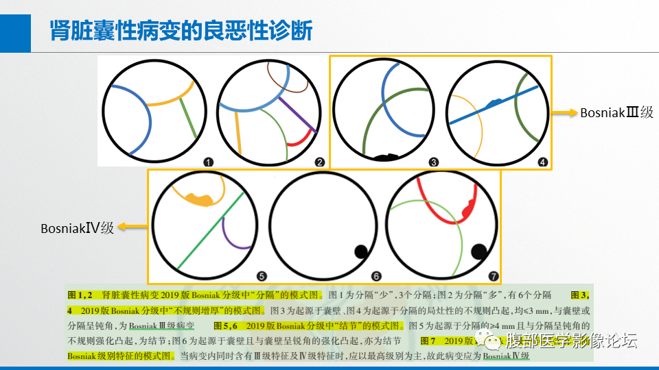 影像PPT - 【PPT】肾癌诊疗指南之诊断篇-11