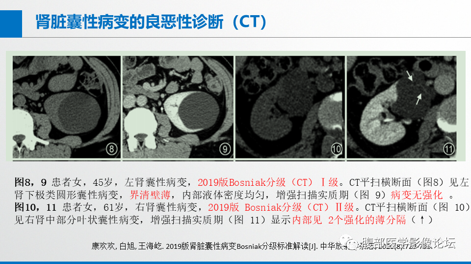 影像PPT - 【PPT】肾癌诊疗指南之诊断篇-12