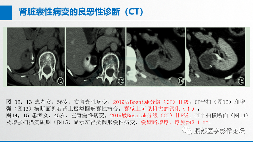 影像PPT - 【PPT】肾癌诊疗指南之诊断篇-13