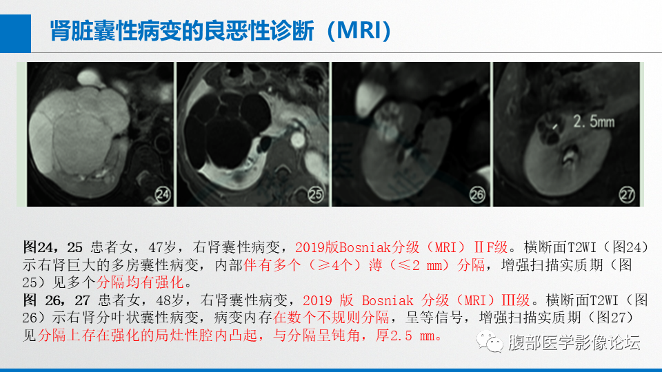 影像PPT - 【PPT】肾癌诊疗指南之诊断篇-16