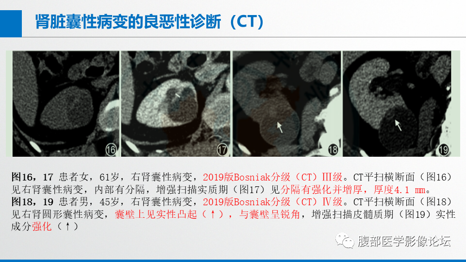 影像PPT - 【PPT】肾癌诊疗指南之诊断篇-14