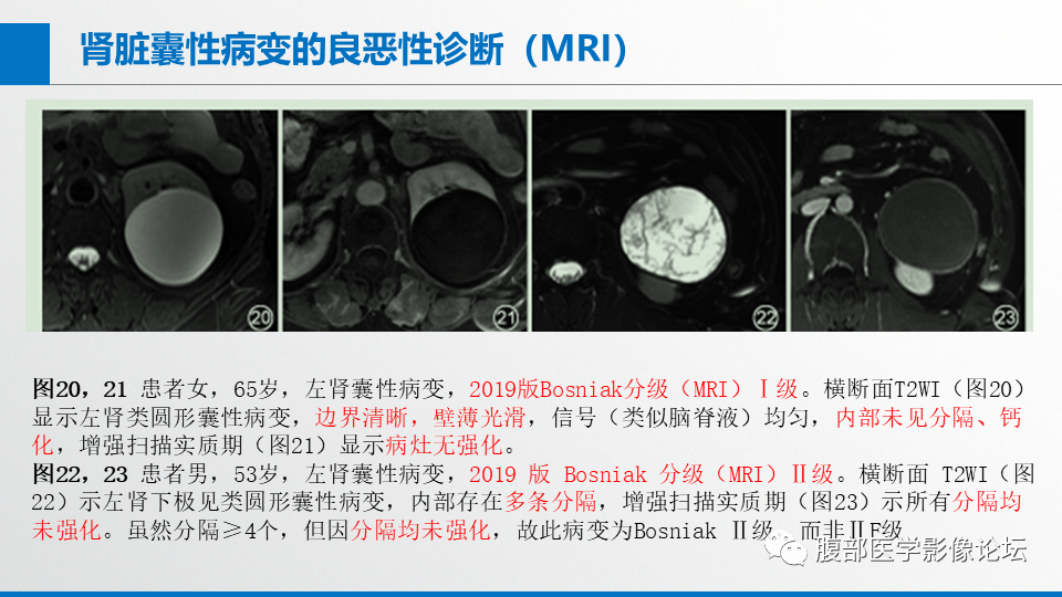 影像PPT - 【PPT】肾癌诊疗指南之诊断篇-15