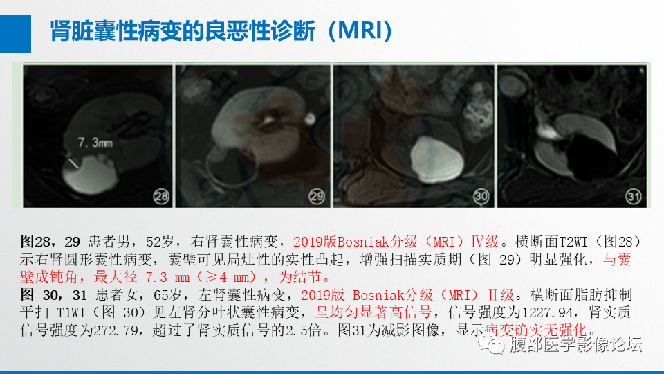 影像PPT - 【PPT】肾癌诊疗指南之诊断篇-17