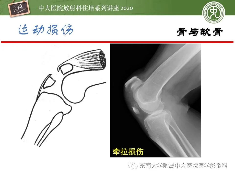 影像PPT - 【PPT】运动损伤的影像解读-8