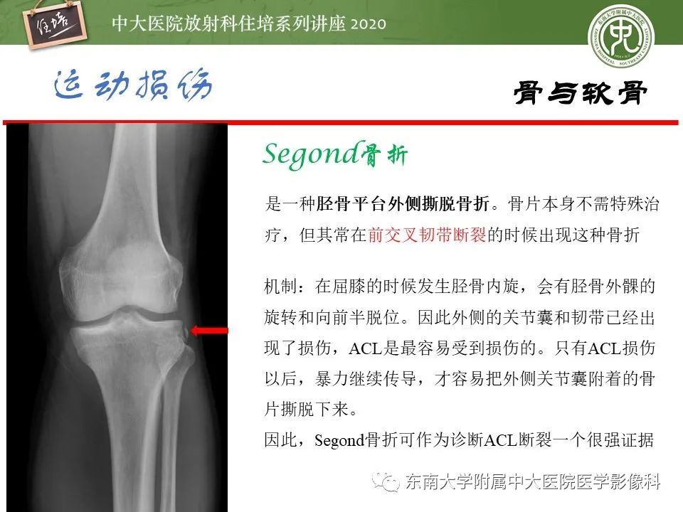 影像PPT - 【PPT】运动损伤的影像解读-10