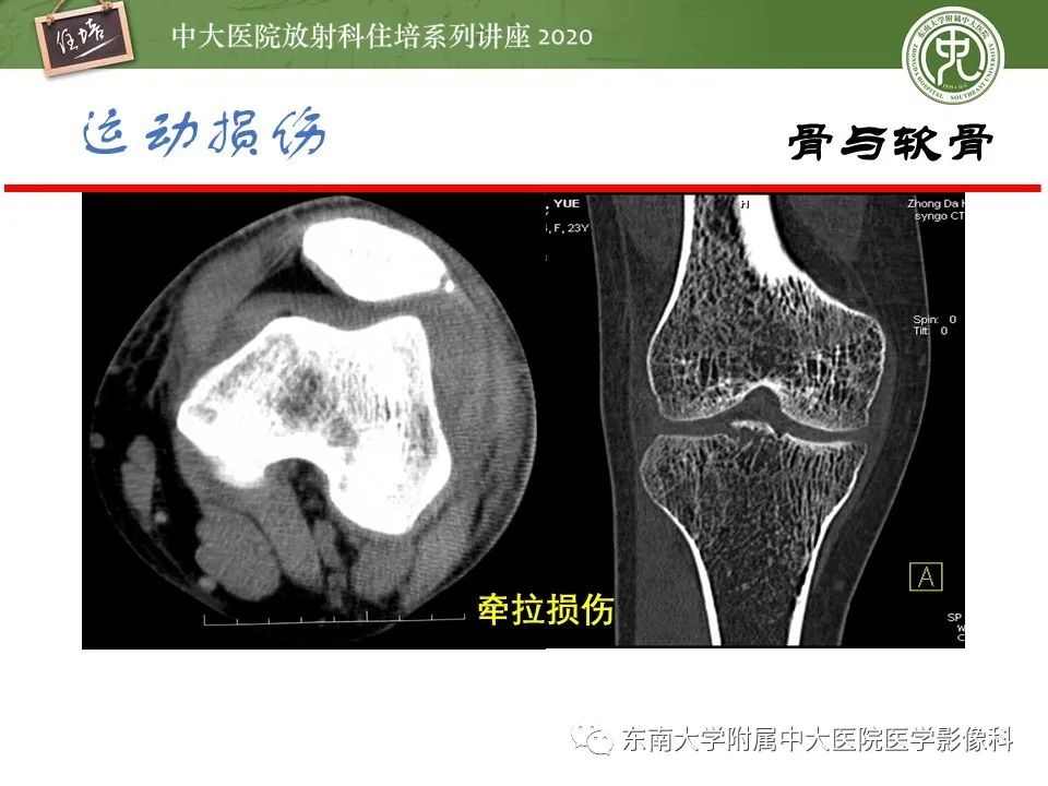 影像PPT - 【PPT】运动损伤的影像解读-9