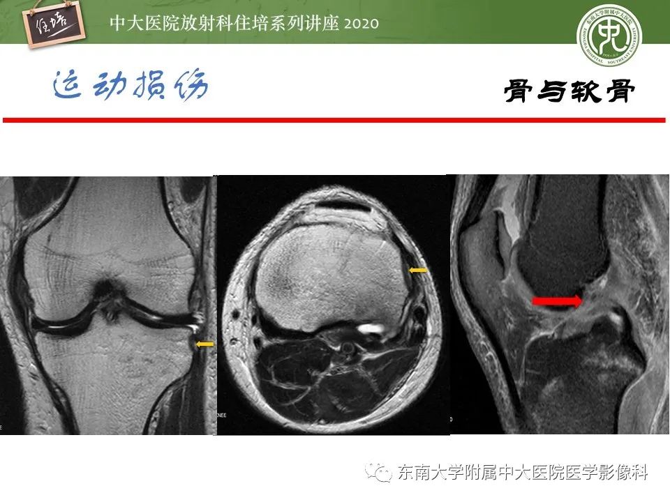 影像PPT - 【PPT】运动损伤的影像解读-11
