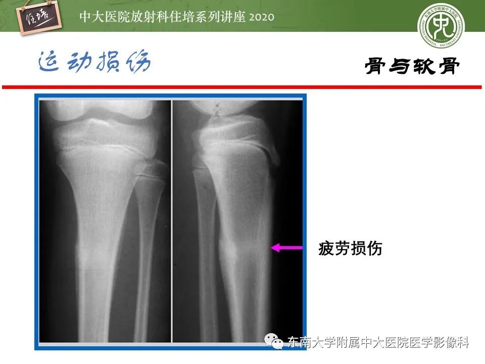 影像PPT - 【PPT】运动损伤的影像解读-12
