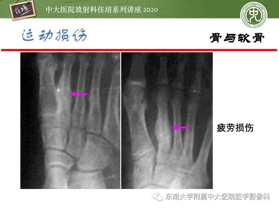 影像PPT - 【PPT】运动损伤的影像解读-13