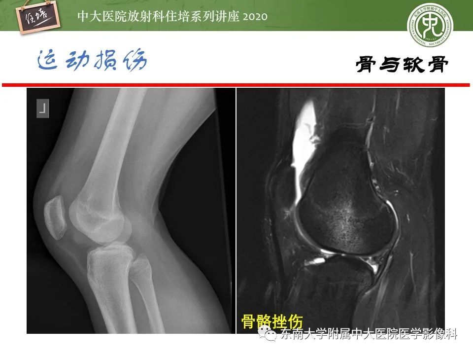 影像PPT - 【PPT】运动损伤的影像解读-14