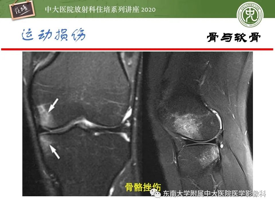 影像PPT - 【PPT】运动损伤的影像解读-15