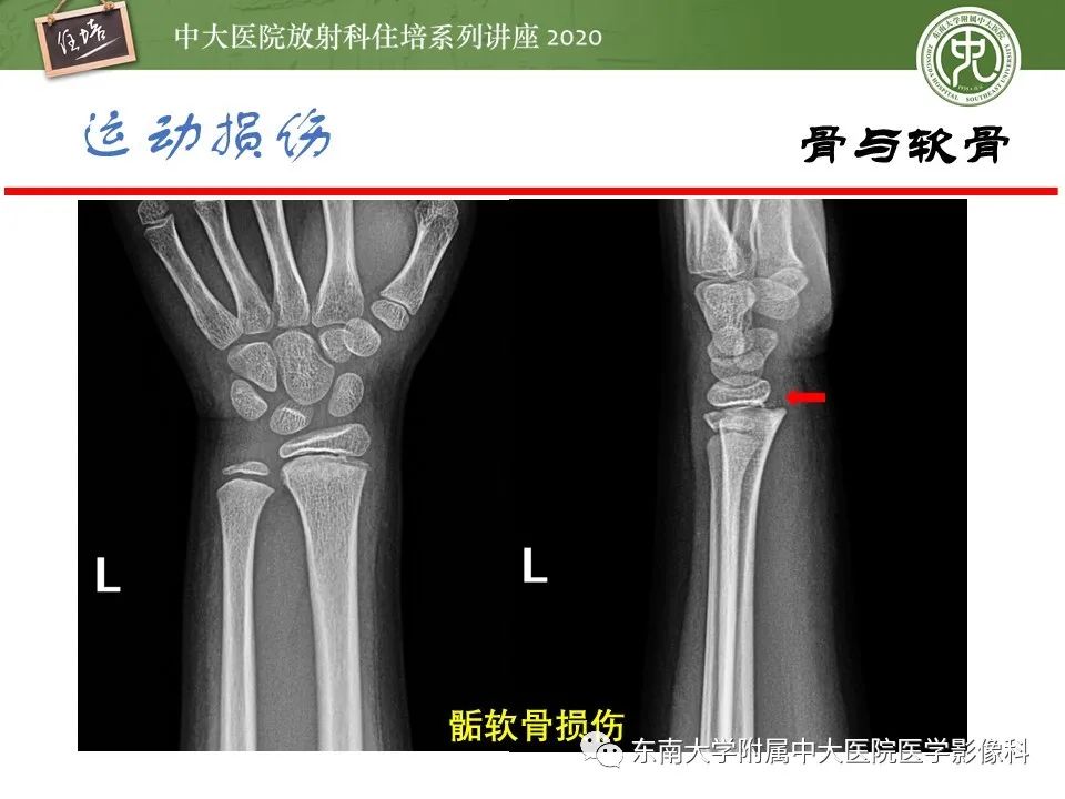 影像PPT - 【PPT】运动损伤的影像解读-16