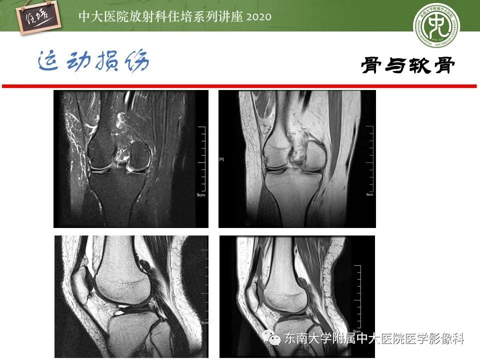 影像PPT - 【PPT】运动损伤的影像解读-17