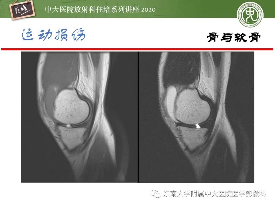 影像PPT - 【PPT】运动损伤的影像解读-18