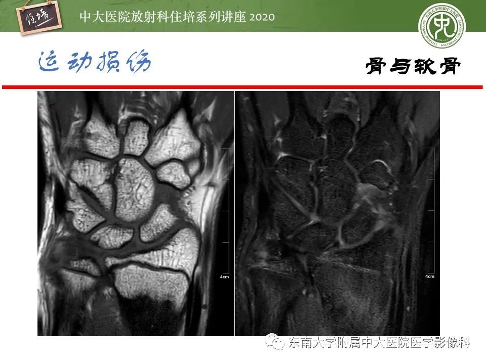 影像PPT - 【PPT】运动损伤的影像解读-19