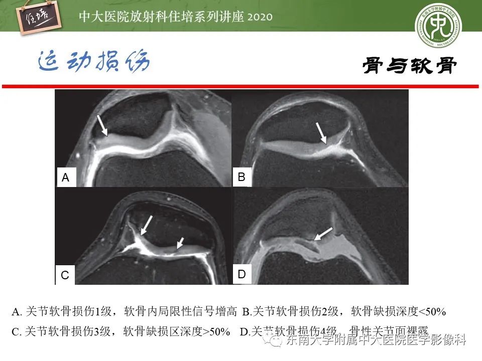 影像PPT - 【PPT】运动损伤的影像解读-20