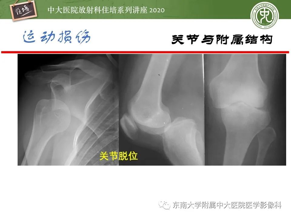 影像PPT - 【PPT】运动损伤的影像解读-25
