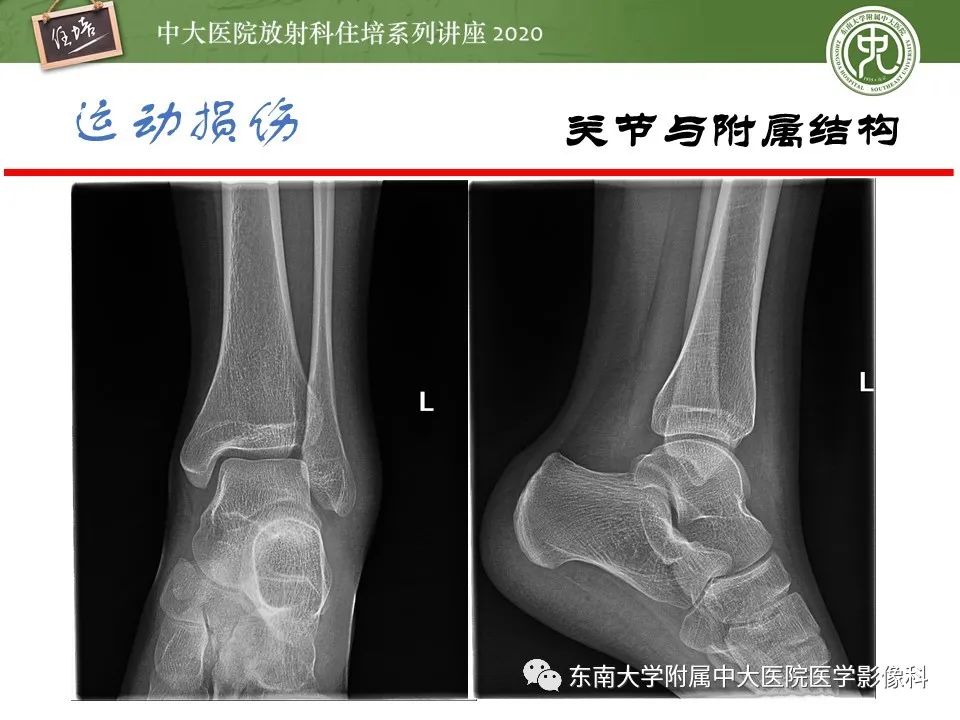 影像PPT - 【PPT】运动损伤的影像解读-26