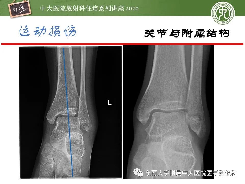 影像PPT - 【PPT】运动损伤的影像解读-27