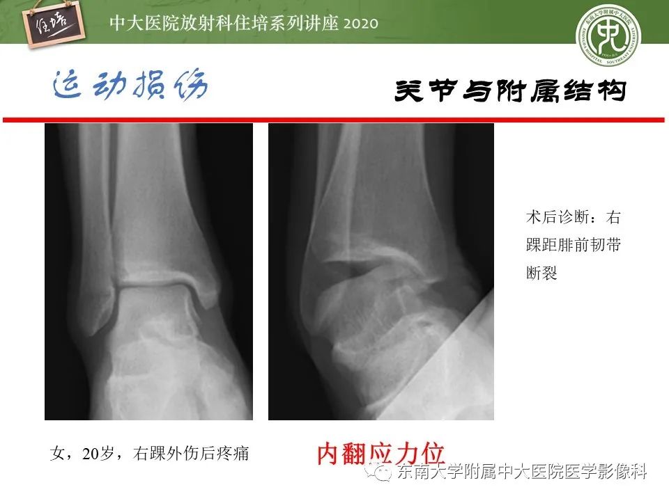 影像PPT - 【PPT】运动损伤的影像解读-28