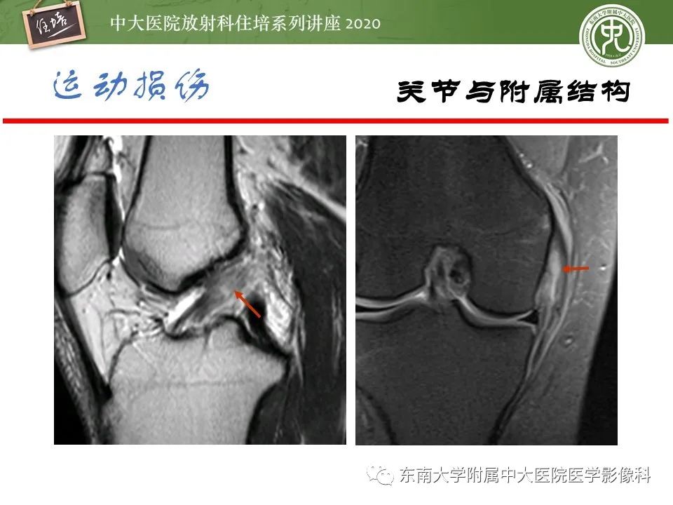 影像PPT - 【PPT】运动损伤的影像解读-29