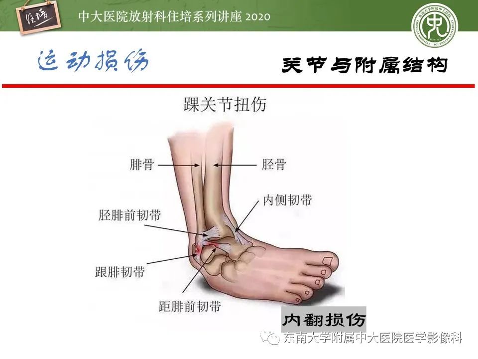影像PPT - 【PPT】运动损伤的影像解读-31