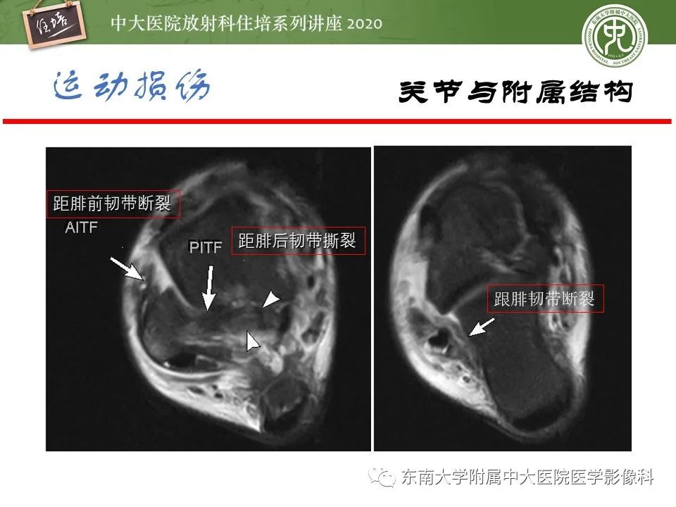 影像PPT - 【PPT】运动损伤的影像解读-32