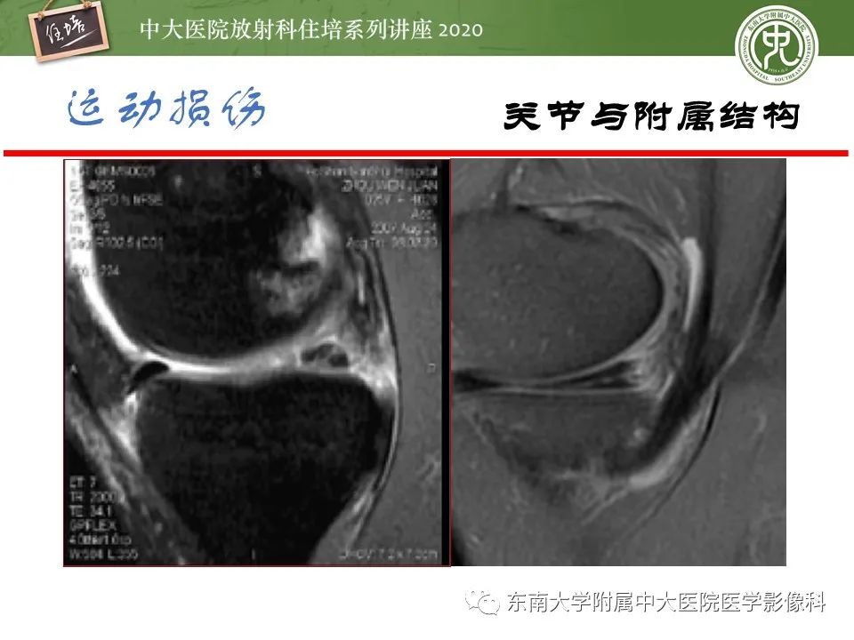 影像PPT - 【PPT】运动损伤的影像解读-34