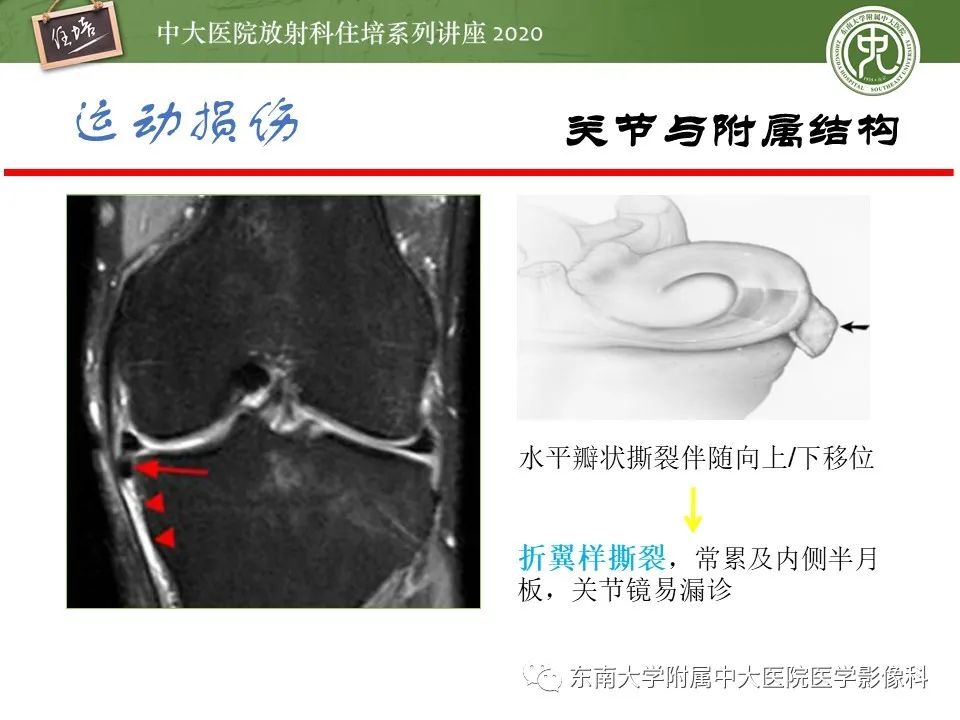 影像PPT - 【PPT】运动损伤的影像解读-35