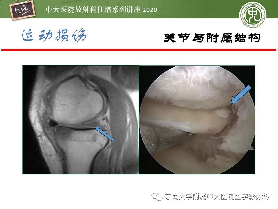 影像PPT - 【PPT】运动损伤的影像解读-36