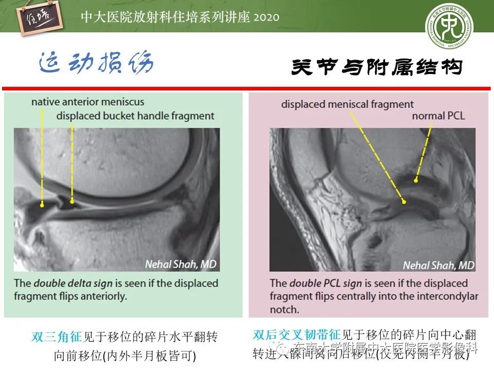 影像PPT - 【PPT】运动损伤的影像解读-37