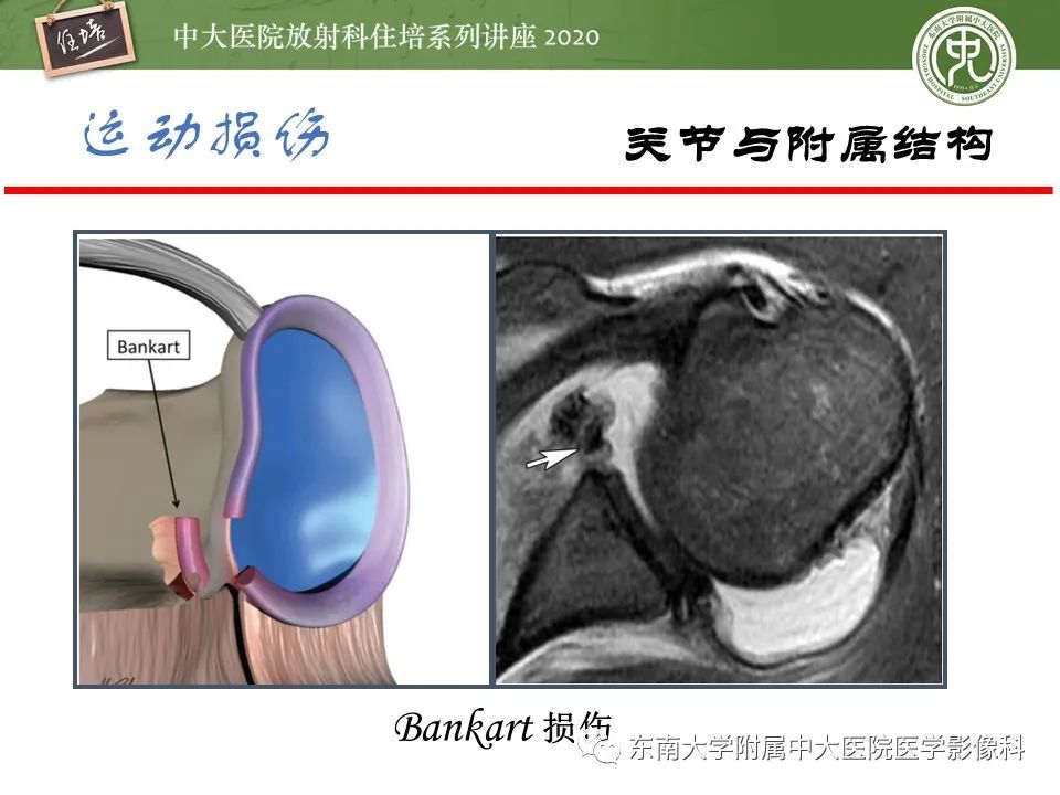 影像PPT - 【PPT】运动损伤的影像解读-38