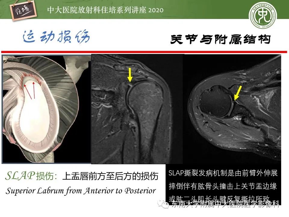 影像PPT - 【PPT】运动损伤的影像解读-39
