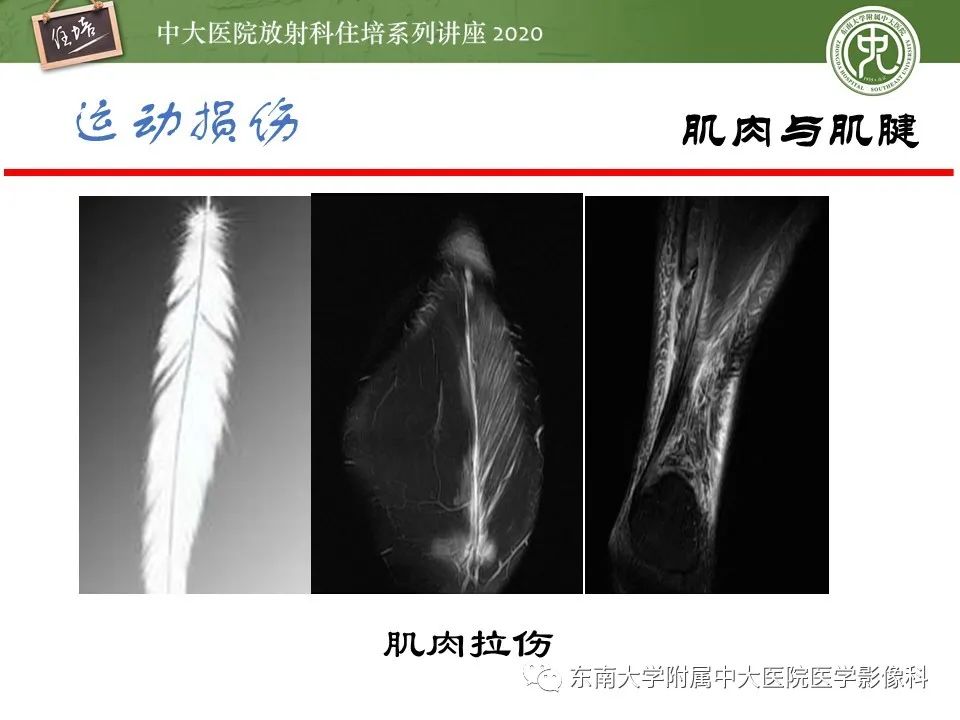 影像PPT - 【PPT】运动损伤的影像解读-41